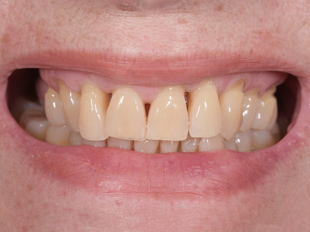 Tercer caso antes del tratamiento con carillas dentales