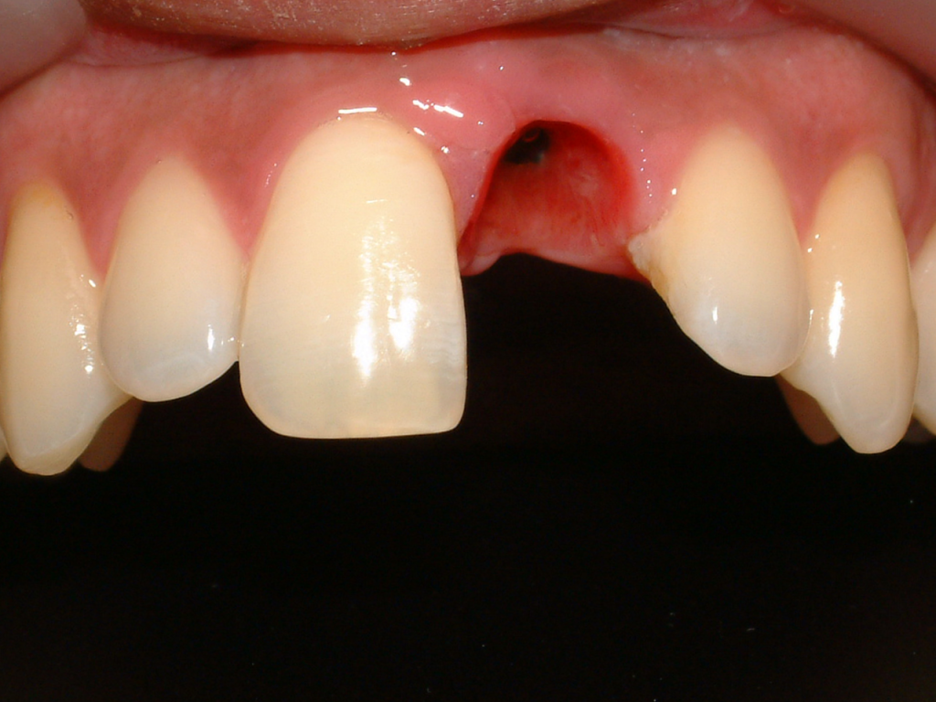 Antes del tratamiento con implantes de carga inmediata