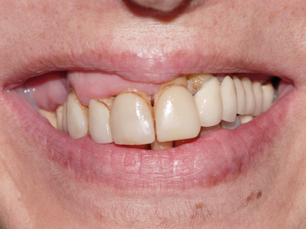 Caso antes de la rehabilitación con prótesis dental