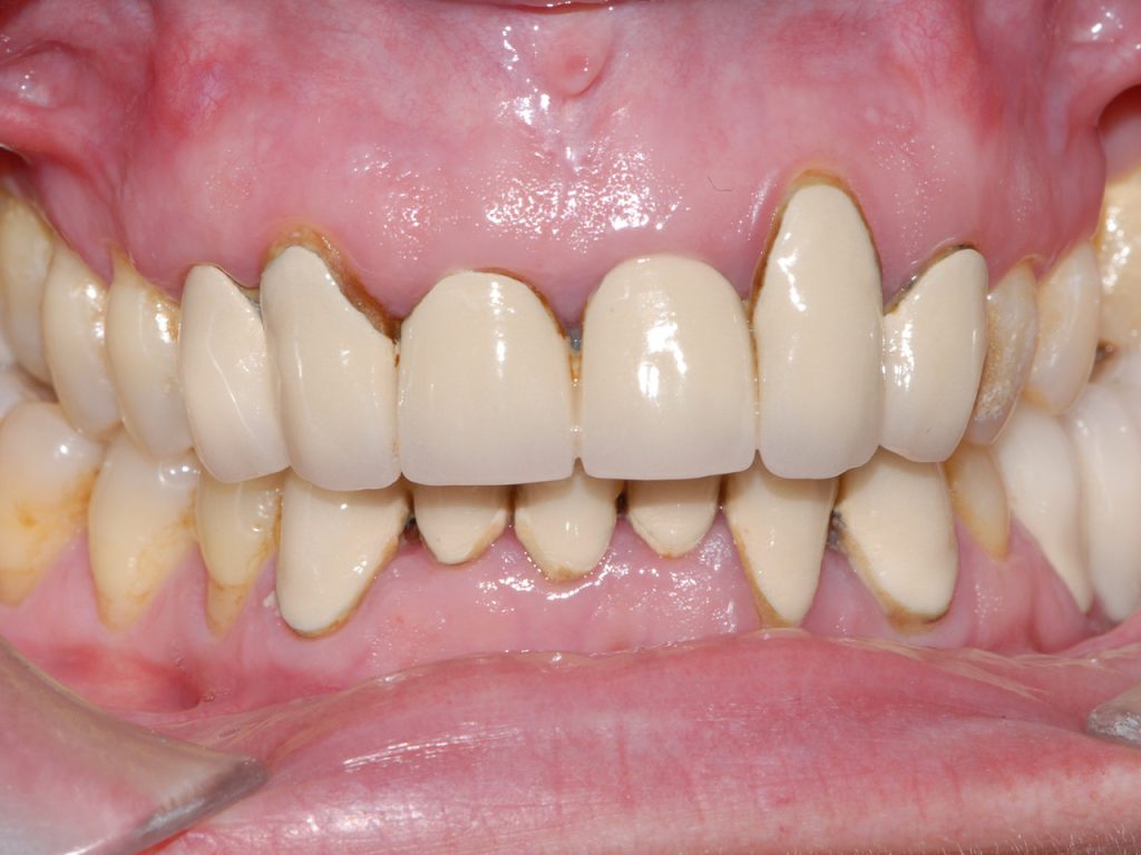 Segundo caso antes del tratamiento con prótesis dental