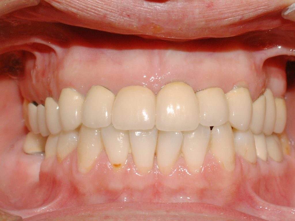 Tercer caso antes del tratamiento con prótesis dental