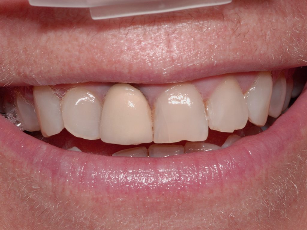 Caso clínico de implantología dental antes del tratamiento