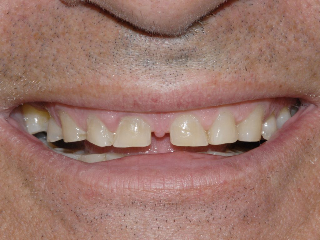 Segundo caso de implantología dental antes del tratamiento