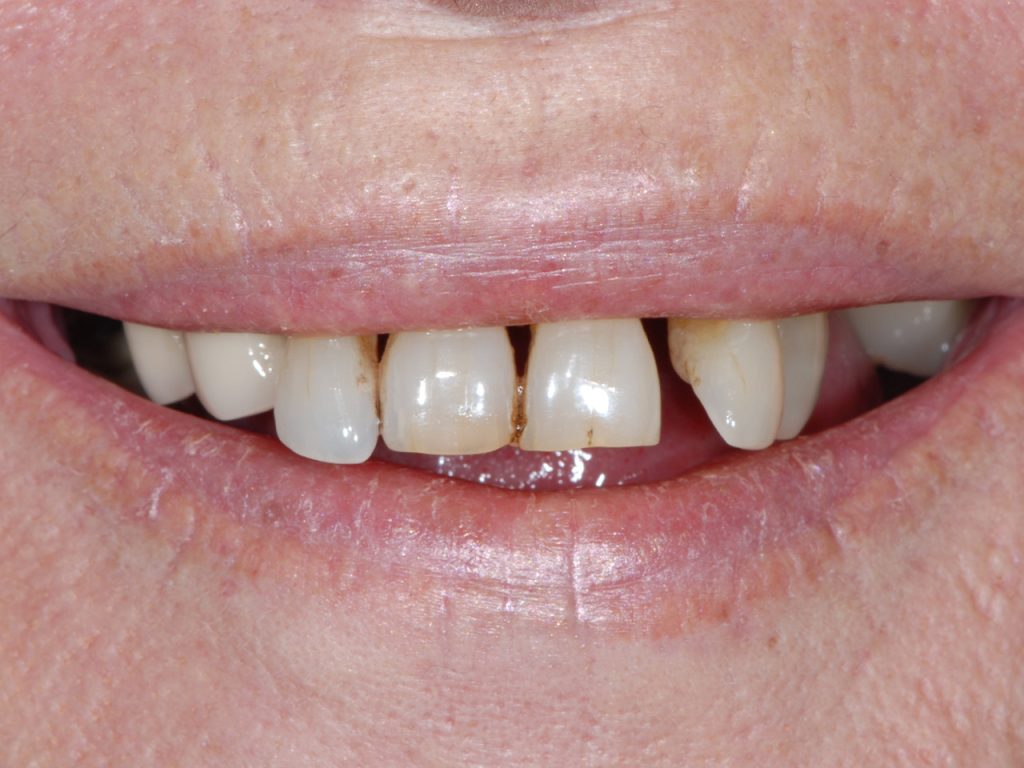 Tercer caso de implantología dental antes del tratamiento