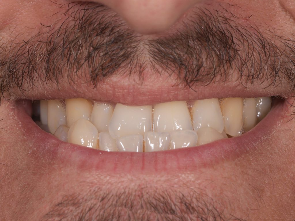 Antes del tratamiento de ortodoncia con Invisalign