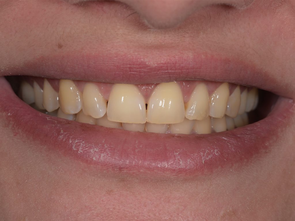 Caso antes del blanqueamiento dental