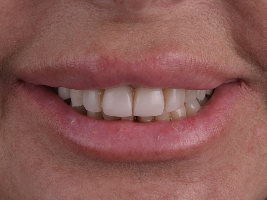 Segundo caso antes del blanqueamiento dental