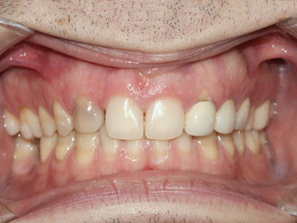 Caso antes del tratamiento con carillas dentales