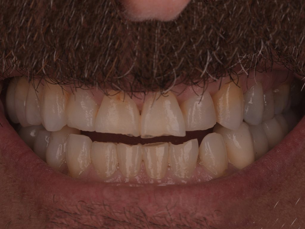 Segundo caso antes de colocar carillas dentales