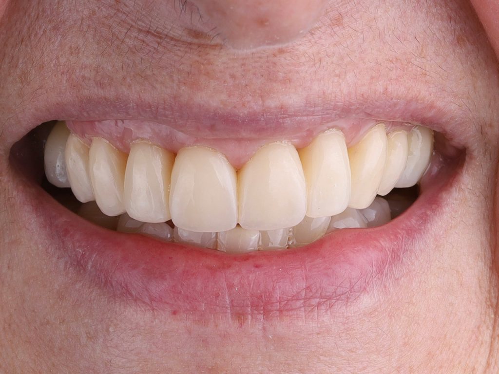 Resultado del tercer caso con carillas dentales