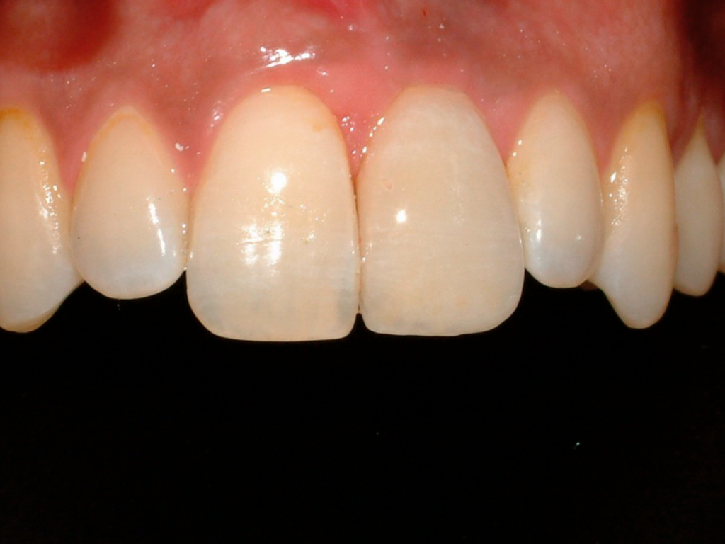 Resultado después de implantes con carga inmediata