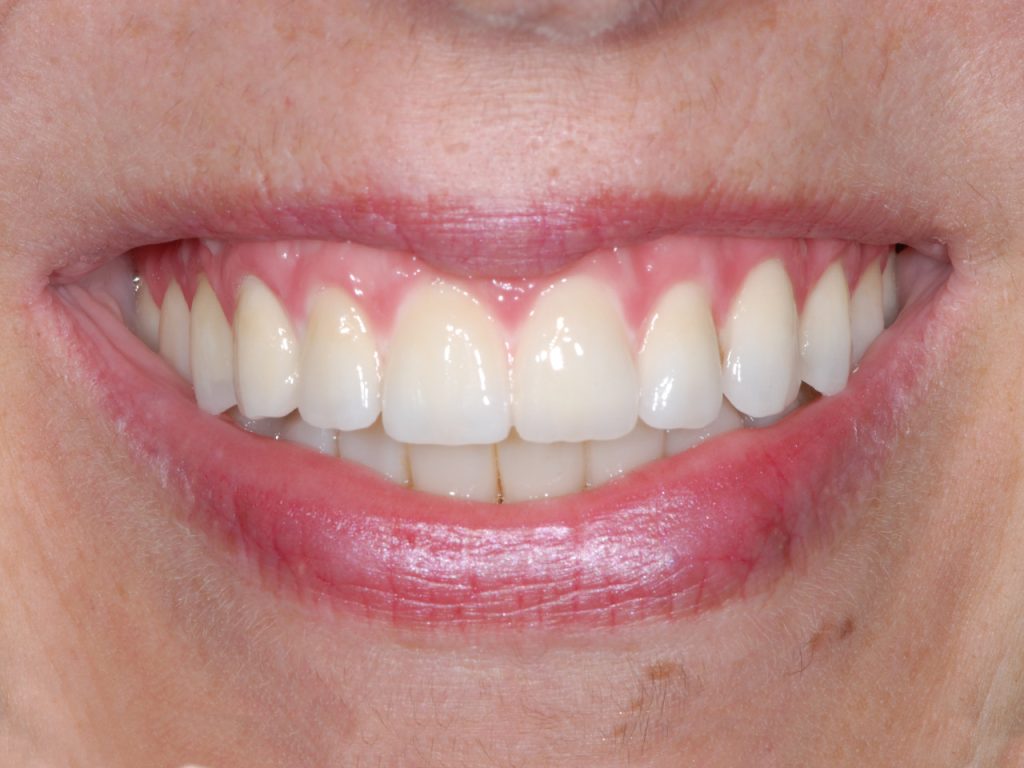 Resultado después de la rehabilitación con prótesis dental