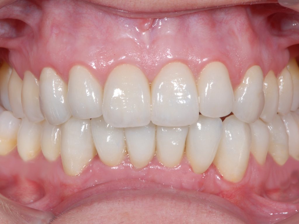 Resultado del segundo caso con prótesis dental