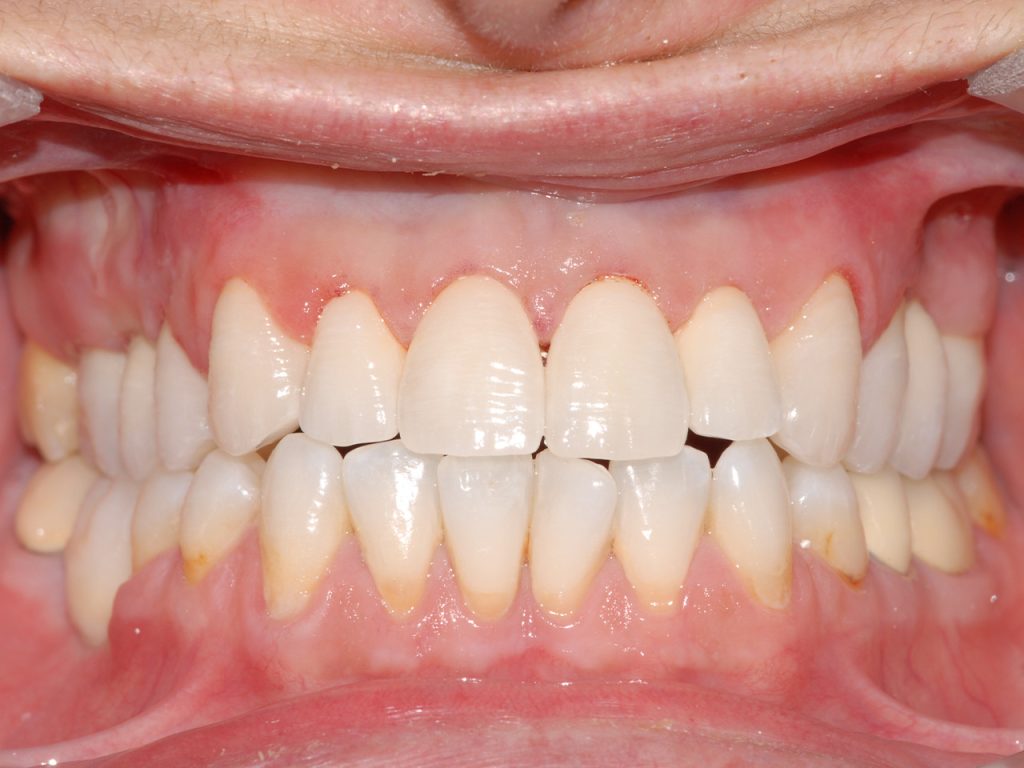 Resultado del tercer caso con prótesis dental