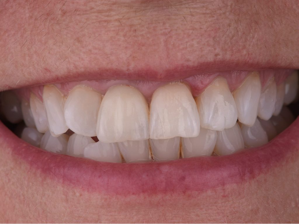 Resultado del caso clínico de implantología dental