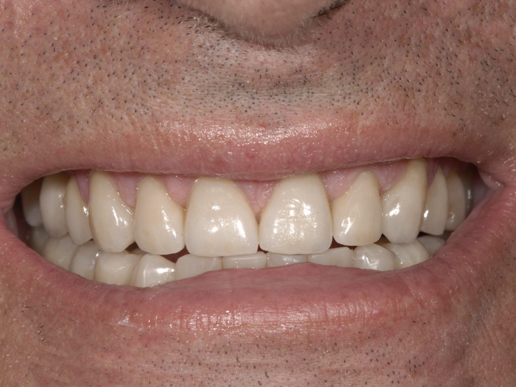 Resultado del segundo caso de implantología dental