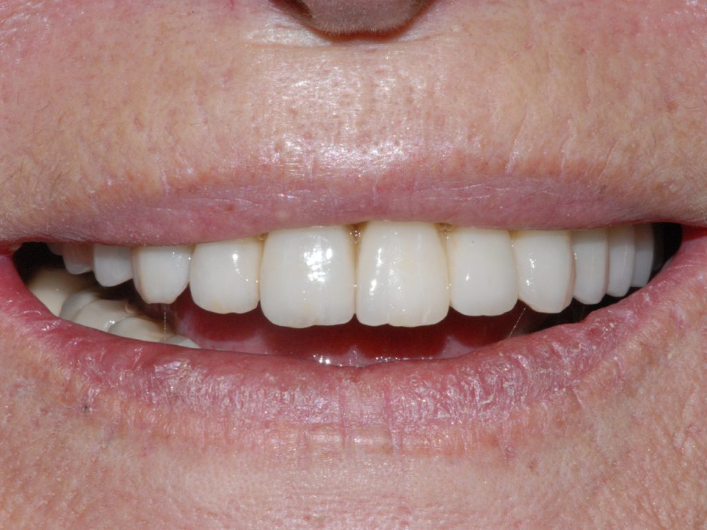 Resultado del tercer caso de implantología dental