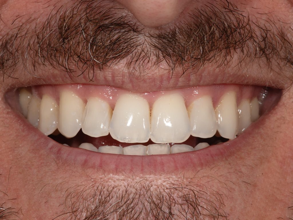 Resultado después del tratamiento con Invisalign