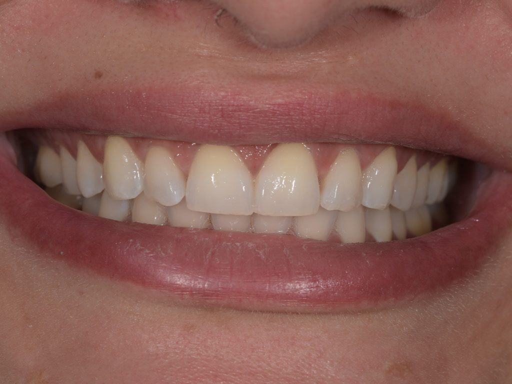 Resultado después del blanqueamiento dental