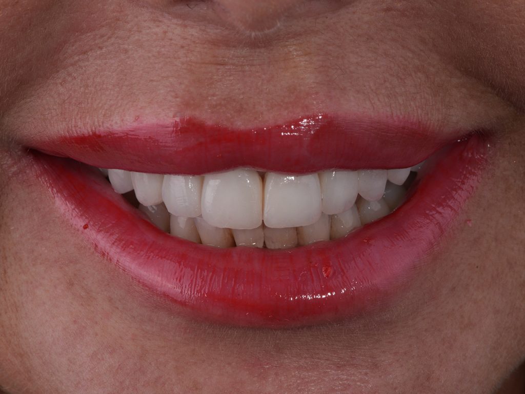 Resultado del segundo caso con blanqueamiento dental