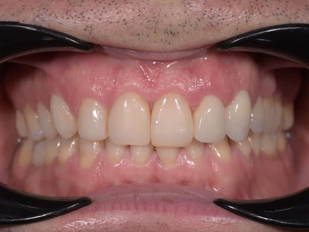 Resultado después del tratamiento con carillas dentales