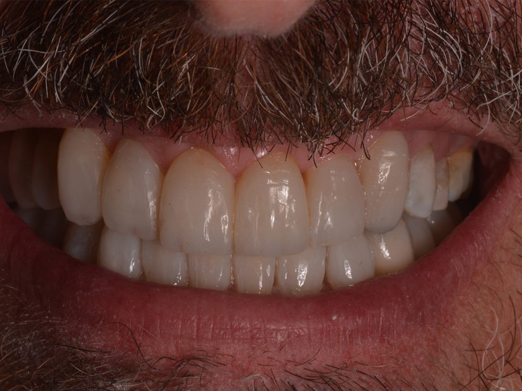 Resultado del segundo caso con carillas dentales