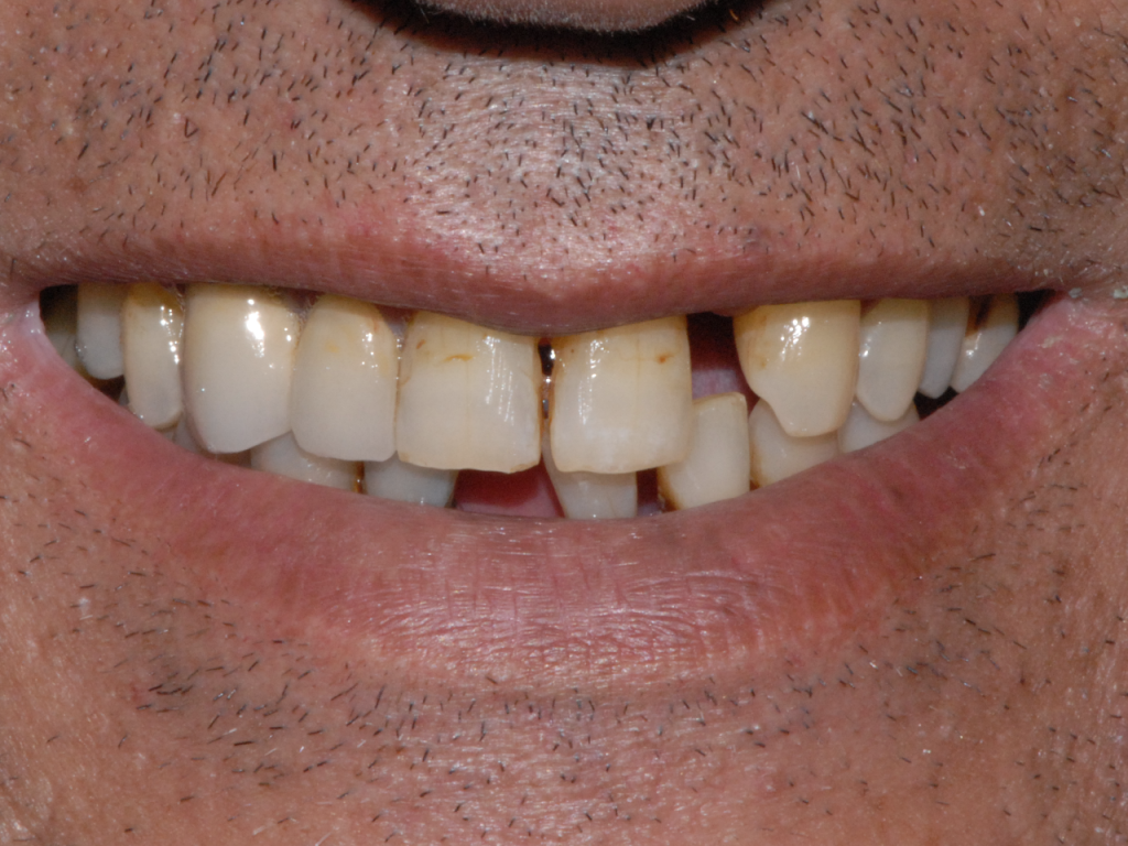 Tratamiento de la periodontitis