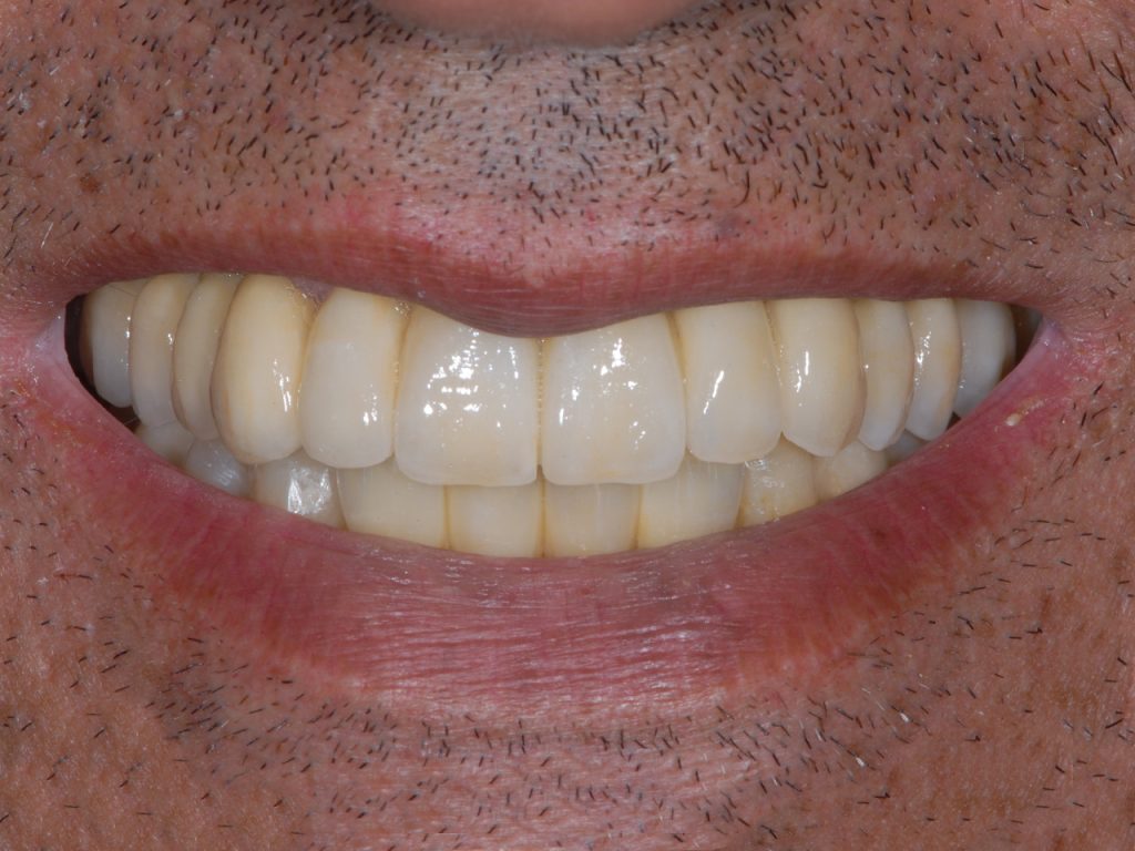 Tratamiento de la periodontitis