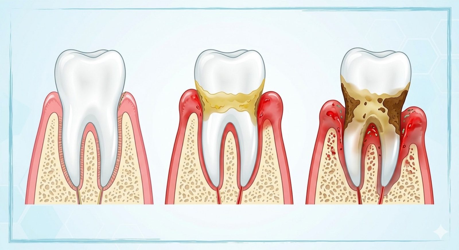 Ilustración de la evolución de una encía sana a enfermedad periodontal avanzada