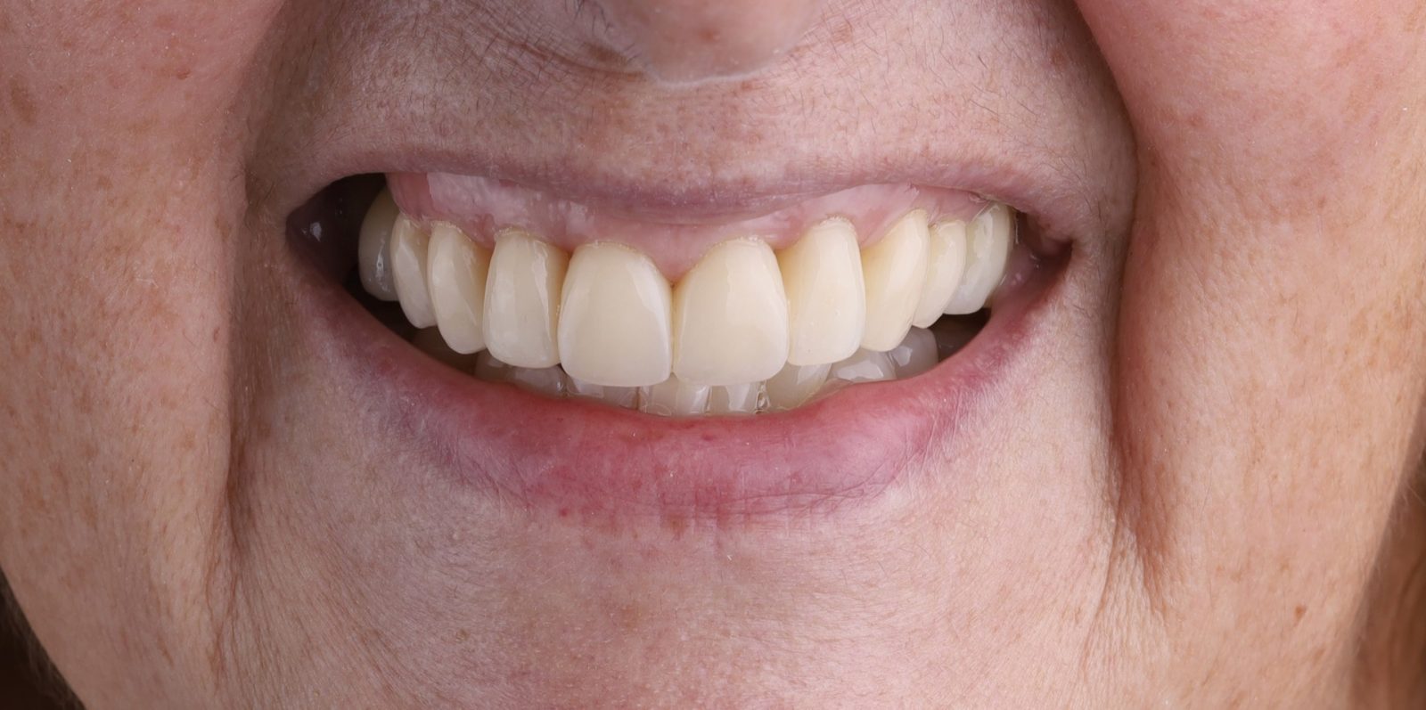 Sonrisa de paciente para un tratamiento de estética dental