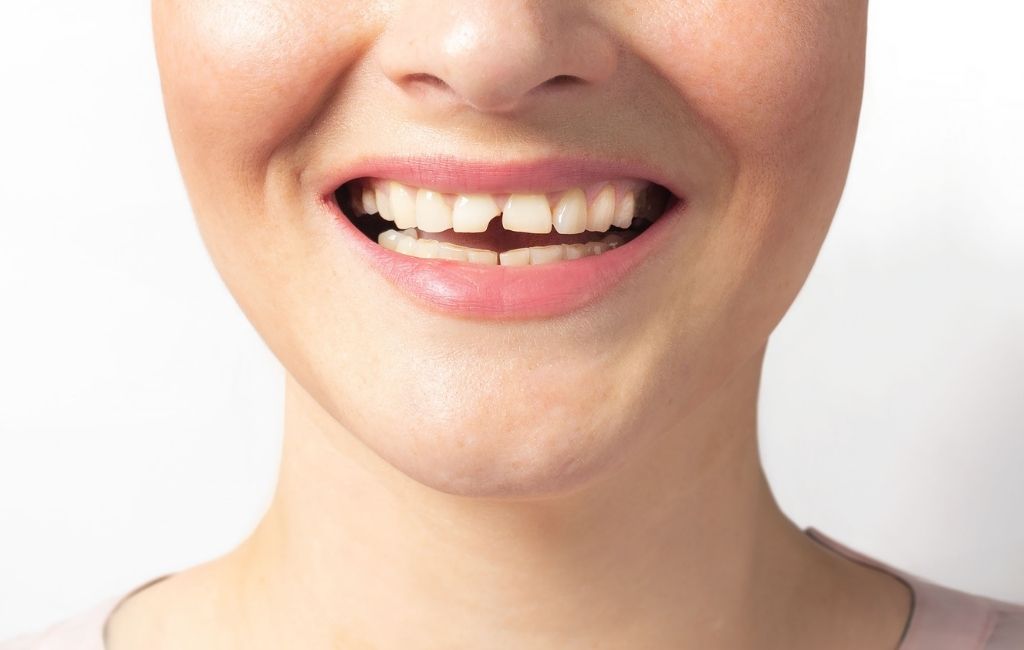 Fractura dental