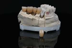Modelo dental real con implantes dentales y coronas protésicas