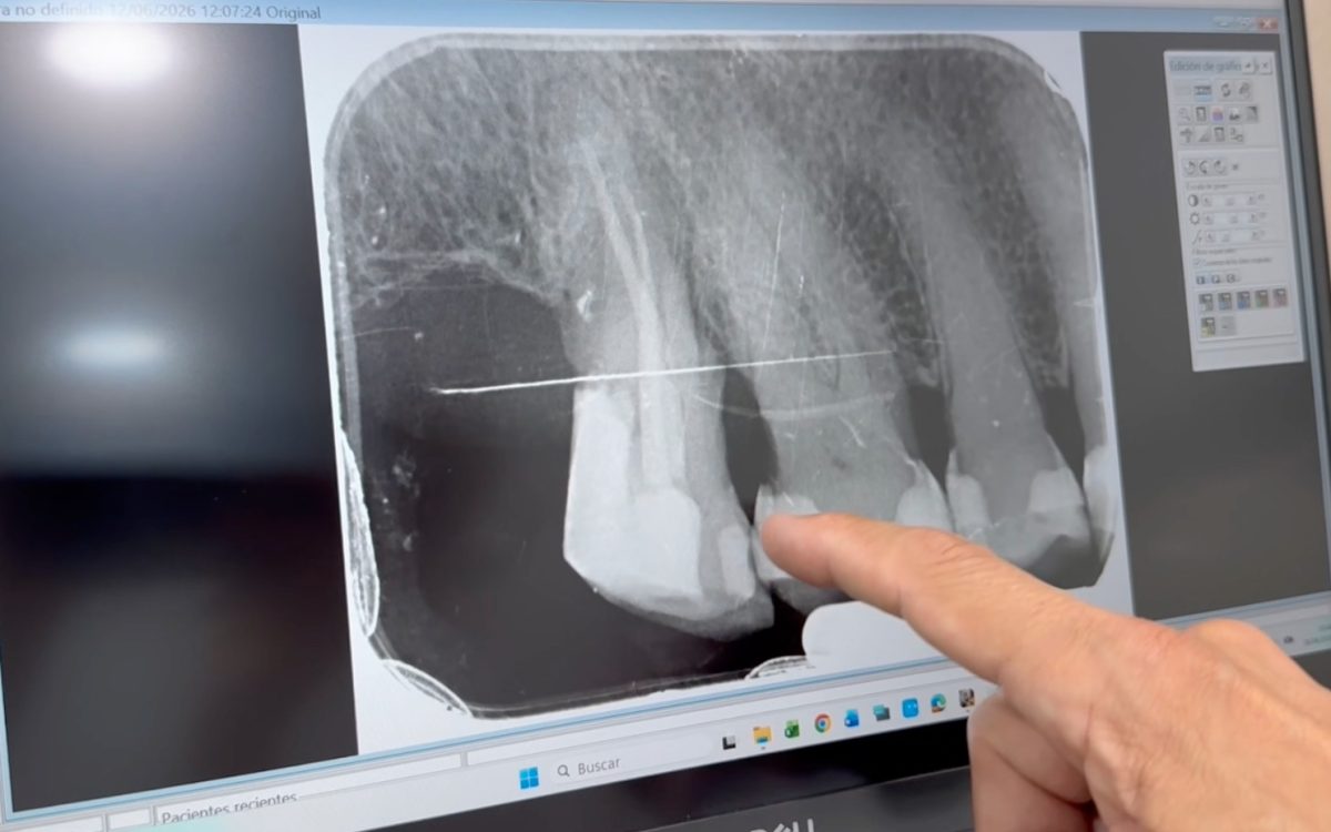 Imagen aportada del caso clínico: radiografía dental mostrada en pantalla