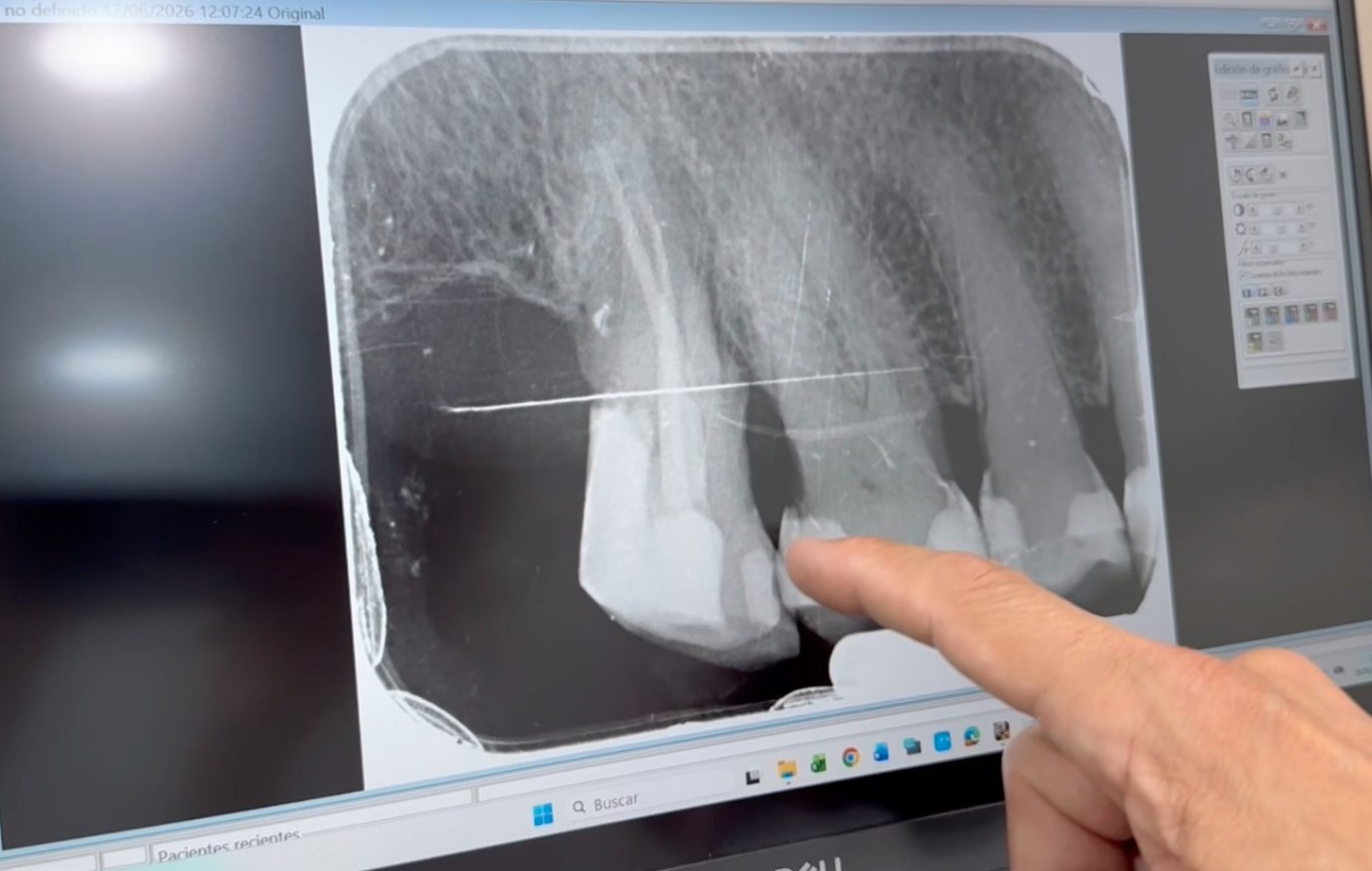 Fractura de raíz dental: diagnóstico con escáner 3D Imagen aportada del caso clínico: radiografía dental mostrada en pantalla