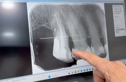 Fractura de la raíz dental: cómo un escáner 3D permite detectar el problema