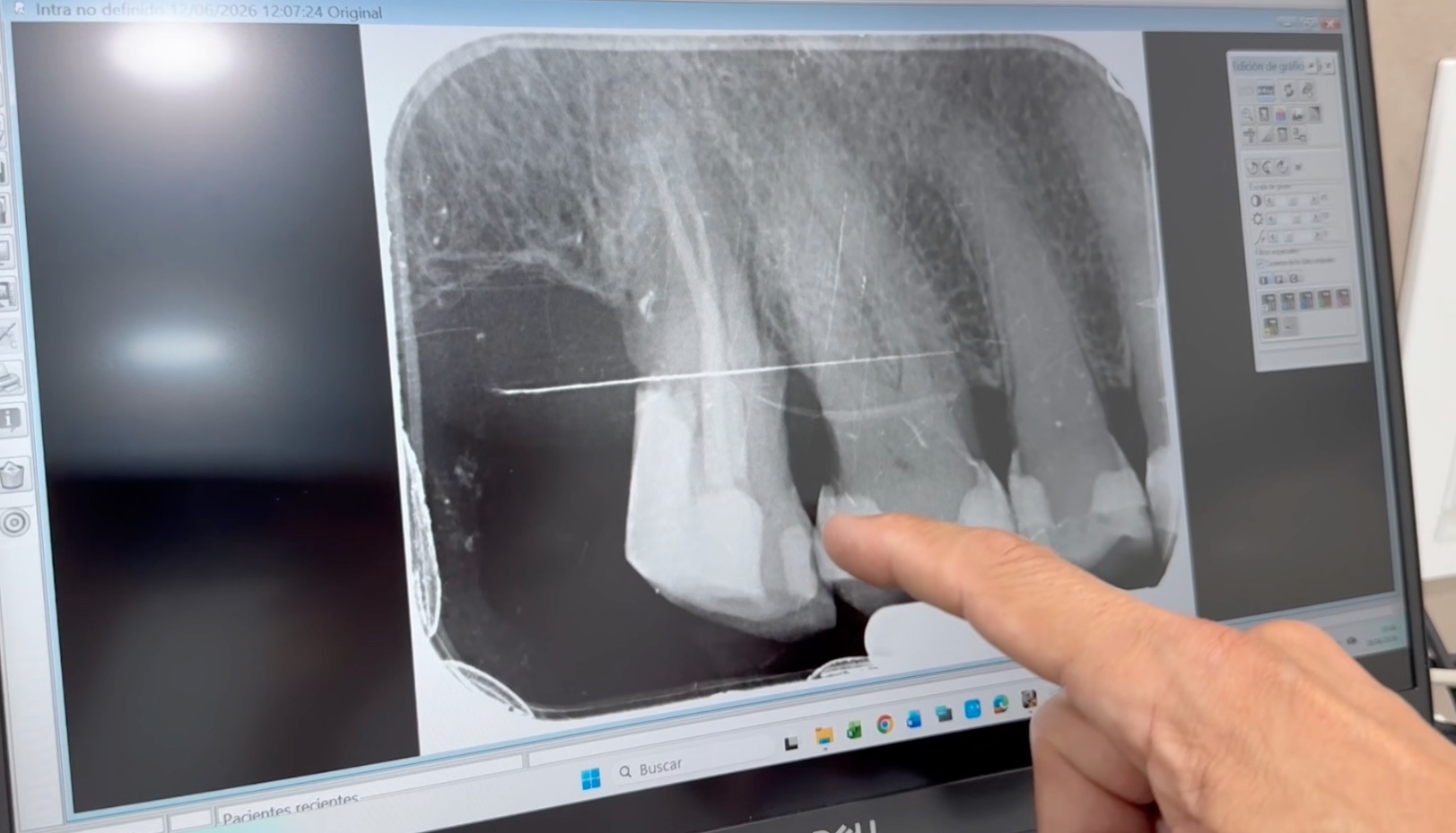 Imagen aportada del caso clínico: radiografía dental mostrada en pantalla